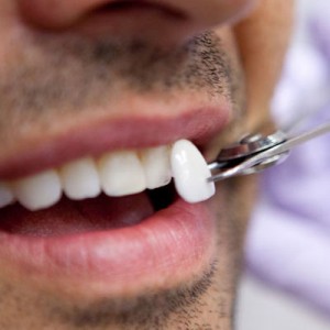 تحدث أسود بليغ  ما هو العلاج المناسب لكسور الاسنان الامامية - موسوعة انا عربي